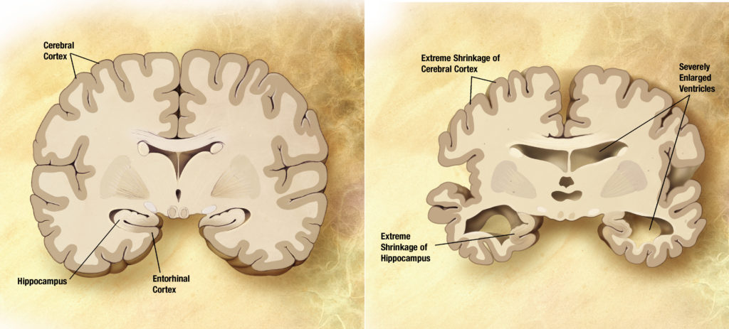 Alzheimer's brain